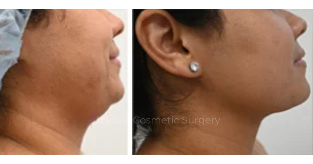 SUBMENTAL-LIPOSUCTION--CHIN--CASE-19225 | Before and After Chin Liposuction