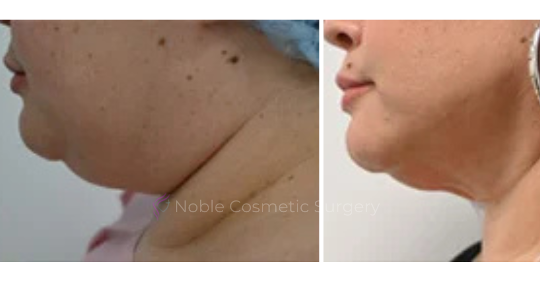 SUBMENTAL-LIPOSUCTION--CHIN--CASE-19226 | Before and After Chin Liposuction