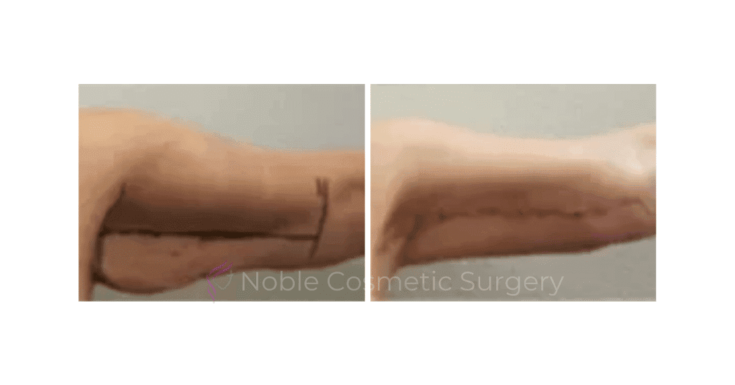 ARM-LIFT-CASE-00255 | Before and After Brachioplasty