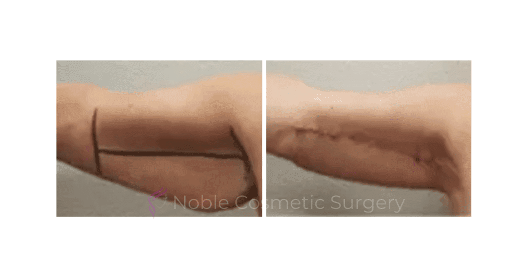 ARM-LIFT-CASE-00255 | Before and After Brachioplasty 2
