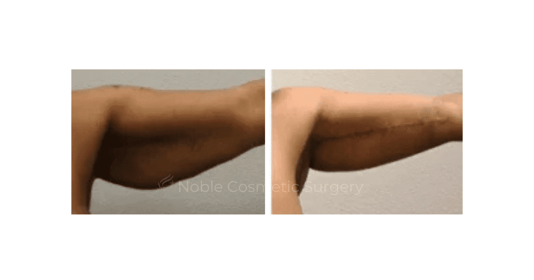 ARM-LIFT-CASE-00252 | Before and After Brachioplasty