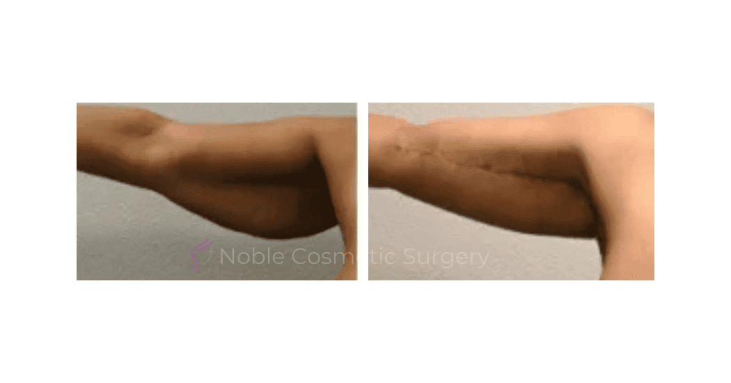 ARM-LIFT-CASE-00252 | Before and After Brachioplasty 2