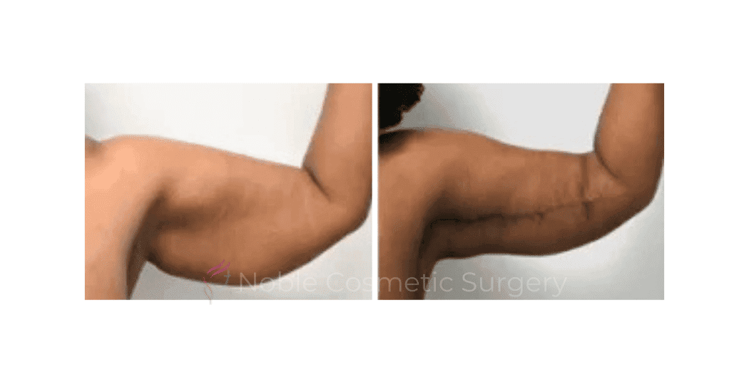 ARM-LIFT-CASE-00254 | Before and After Brachioplasty