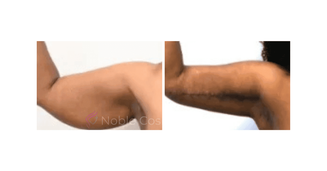 ARM-LIFT-CASE-00254 | Before and After Brachioplasty 2