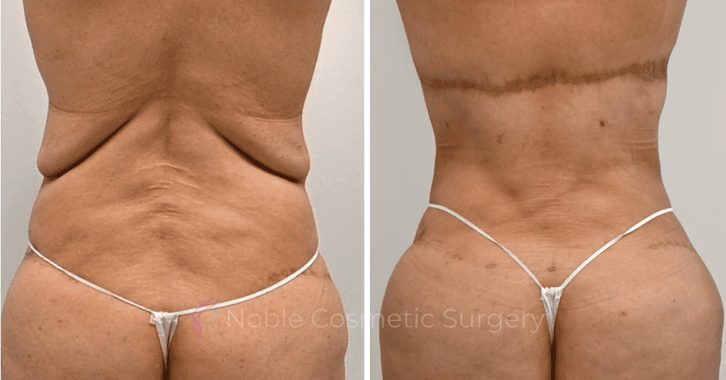 BACK-LIFT-CASE-00251 | Before and After Back Lift