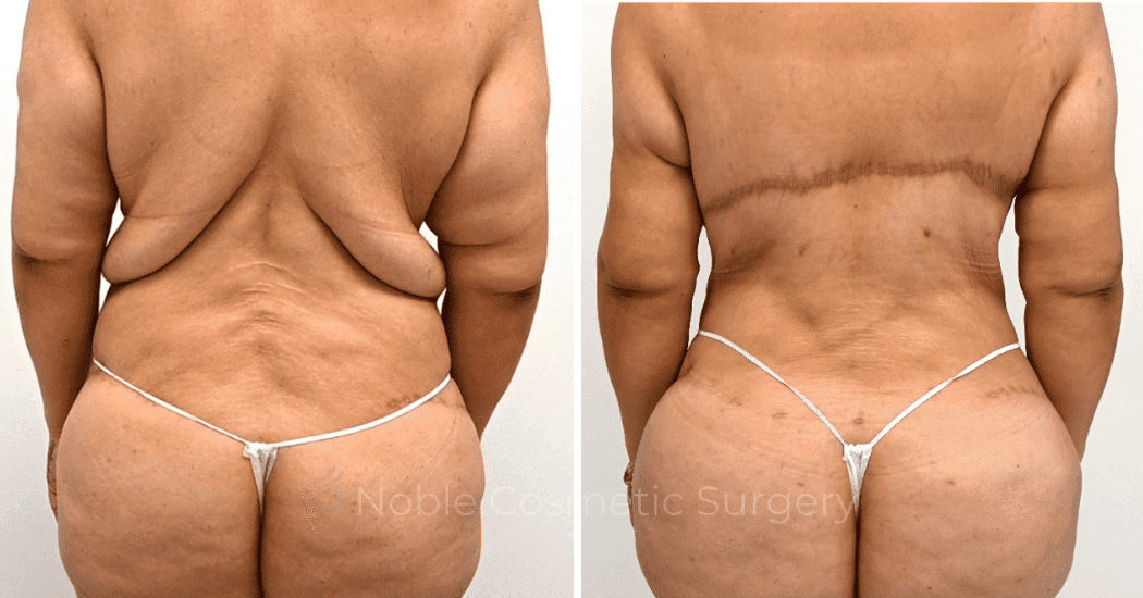 BACK-LIFT-CASE-00251 | Before and After Back Lift 2