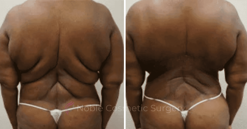 BACK-LIFT-CASE-00252 | Before and After Back Lift