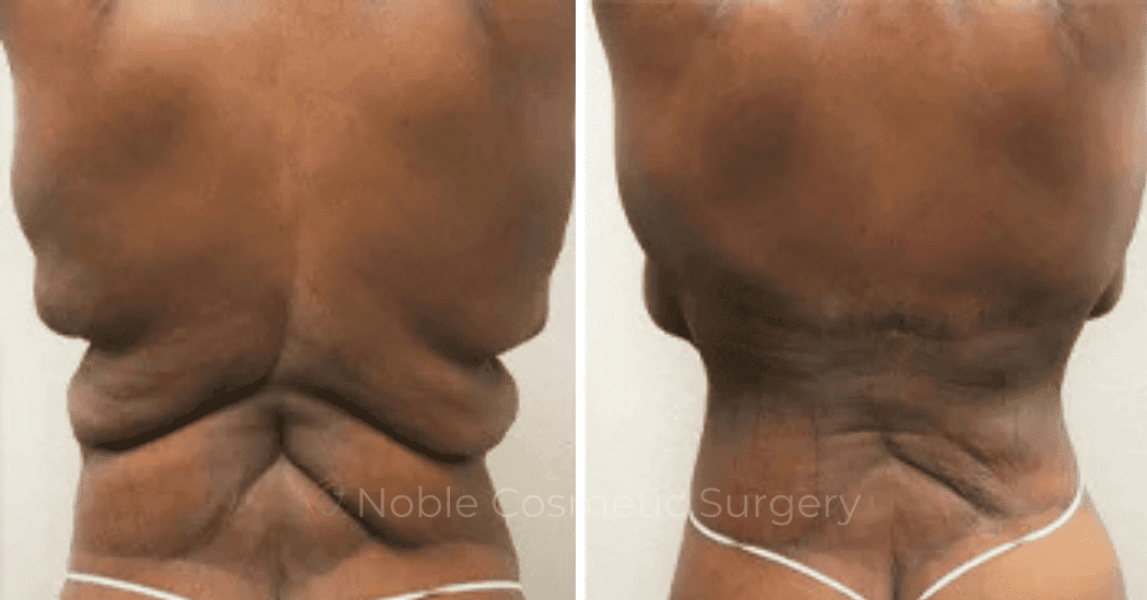 BACK-LIFT-CASE-00252 | Before and After Back Lift 2