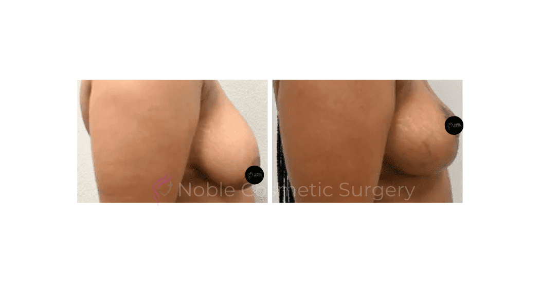 BREAST-LIFT-CASE-00513 | Before and After Breast Lift 3