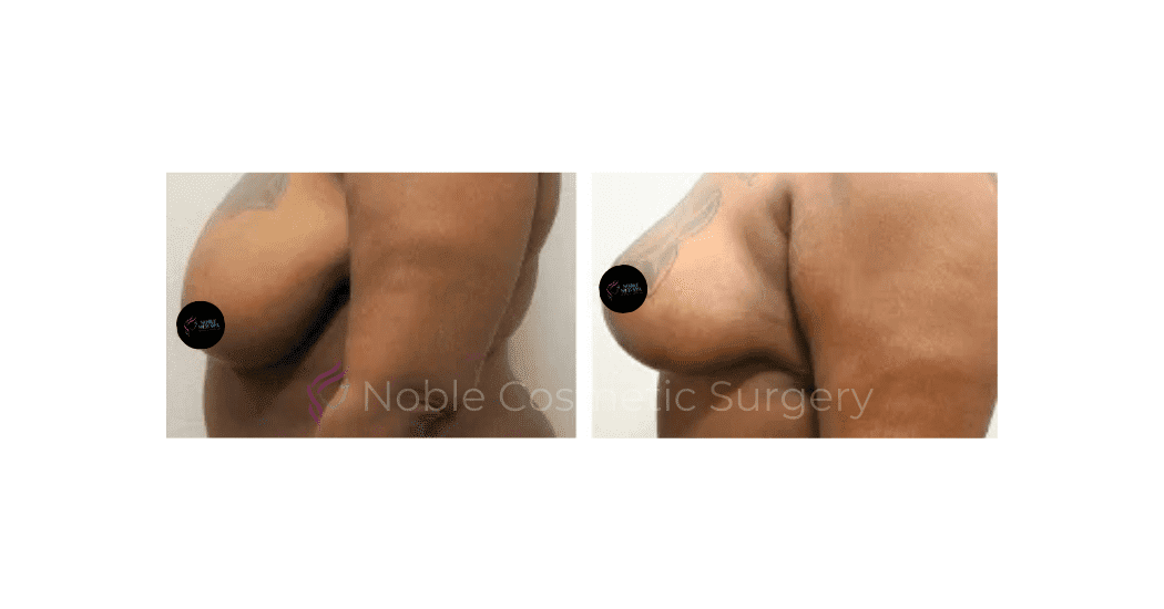 BREAST-LIFT-CASE-00516 | Before and After Breast Lift 2