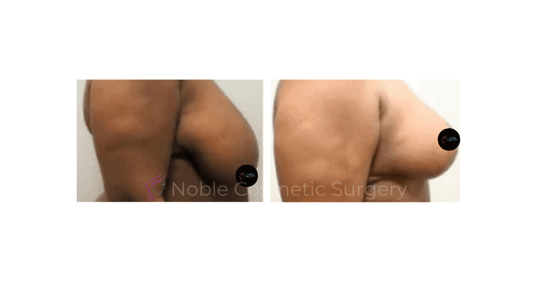 BREAST-LIFT-CASE-00516 | Before and After Breast Lift 3
