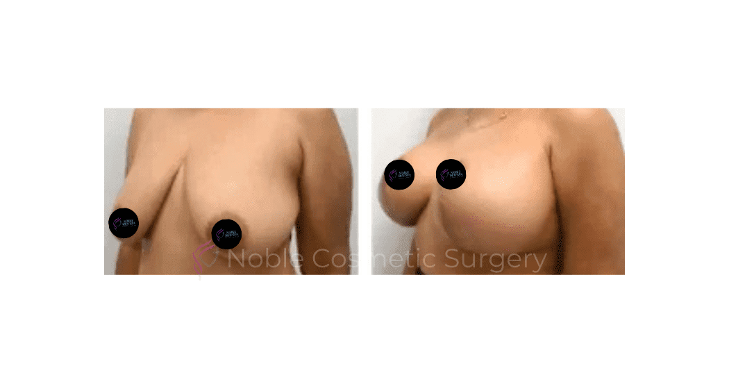 BREAST-LIFT-CASE-00517 | Before and After Breast Lift 2