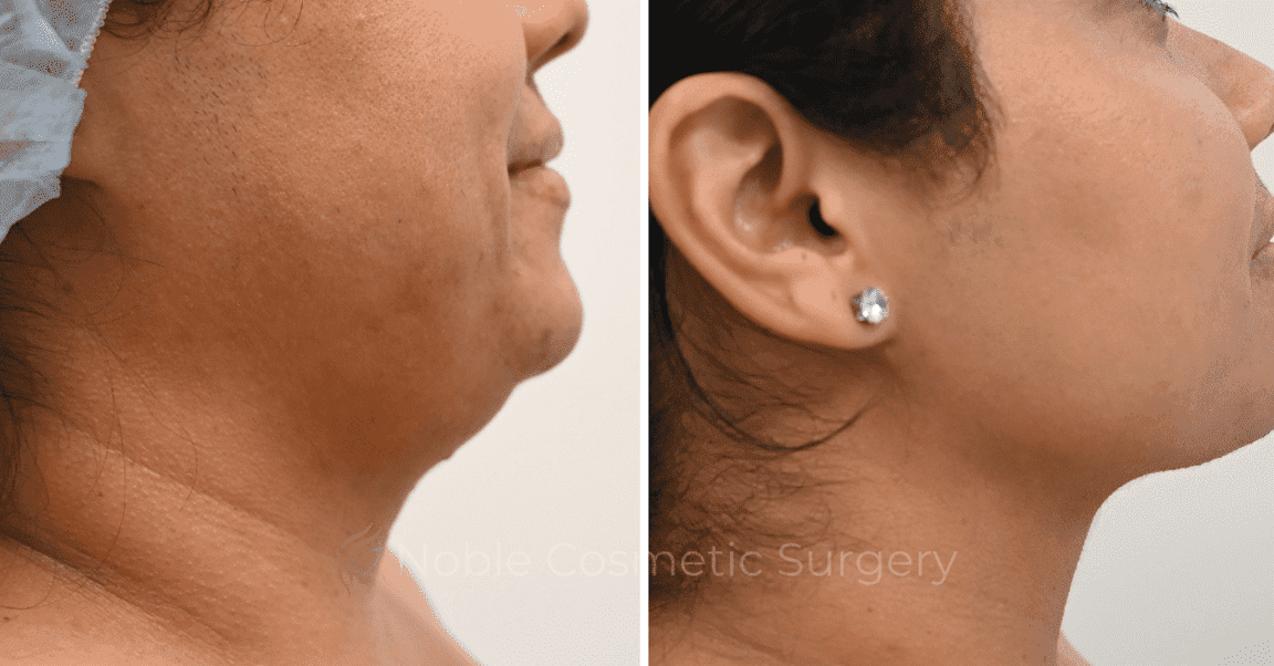 SUBMENTAL-LIPOSUCTION-CASE-12466 | Before and After Chin Liposuction 2