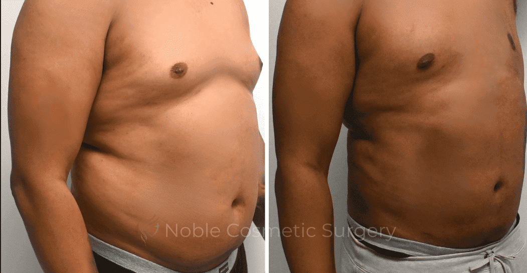LIPOSUCTION-ABDOMEN-CASE-10135 | Before and After Male Liposuction 2