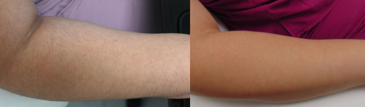 Laser-Hair-Removal--Case--1292 | Before and After Laser Hair Removal