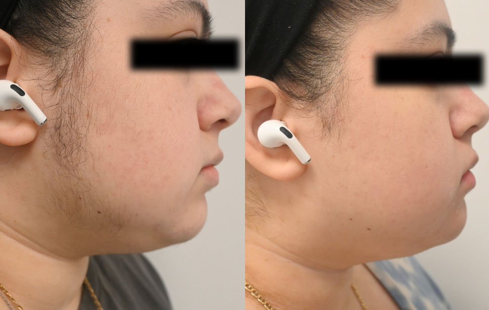 Laser-Hair-Removal-Case--8237 | Before and After Laser Hair Removal