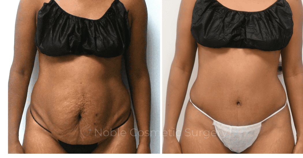 TUMMY-TUCK-CASE-12299 | Before and After Abdominoplasty 1