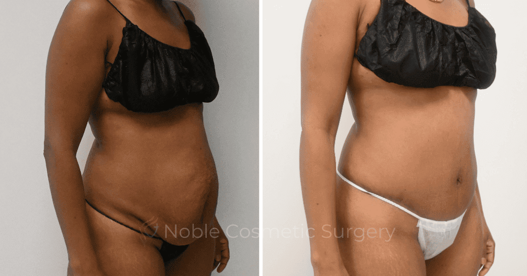 TUMMY-TUCK-CASE-12299 | Before and After Abdominoplasty 2