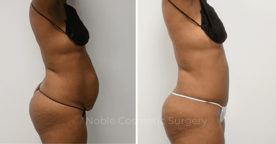 TUMMY-TUCK-CASE-12299 | Before and After Abdominoplasty 3