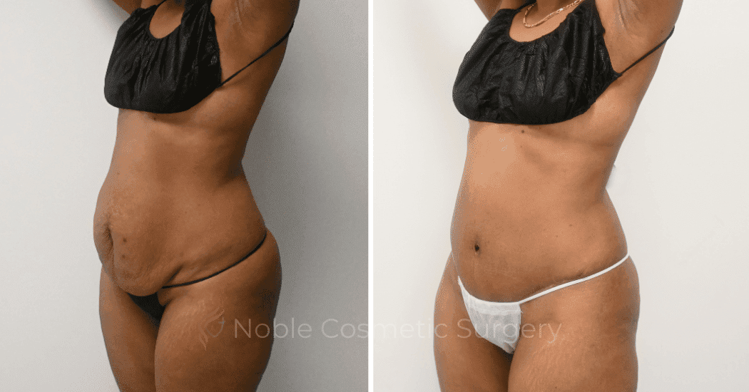 TUMMY-TUCK-CASE-12299 | Before and After Abdominoplasty 4