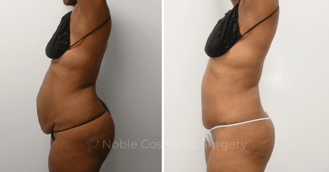 TUMMY-TUCK-CASE-12299 | Before and After Abdominoplasty 5